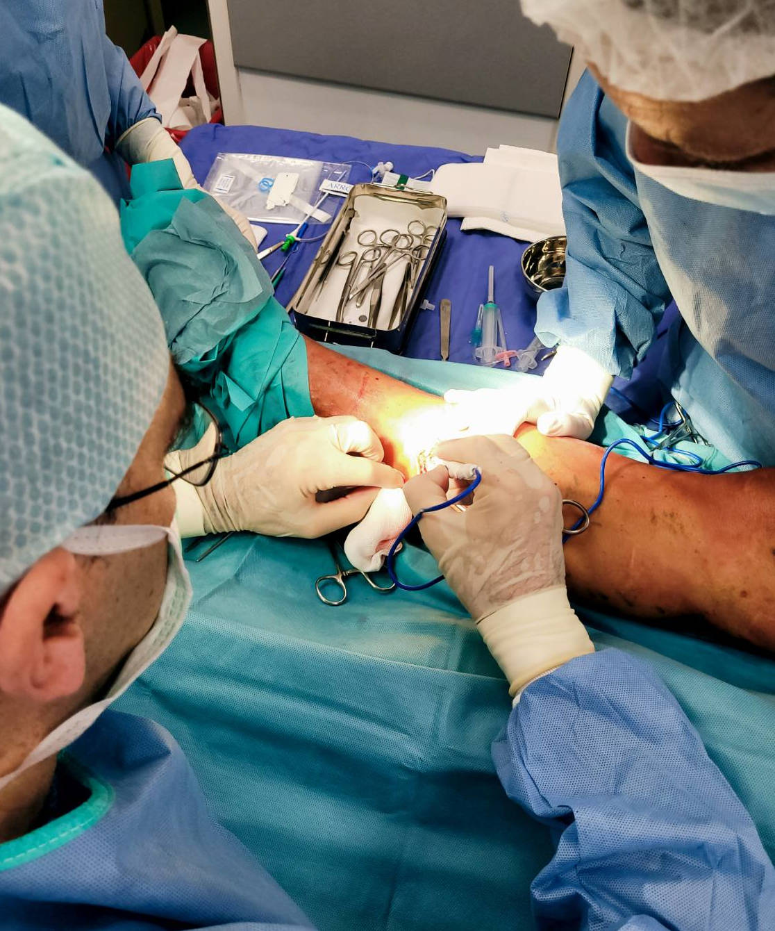 Uporaba električnega noža je neizogiben manever dobre kirurške tehnike pri odprti operaciji krčnih žil.